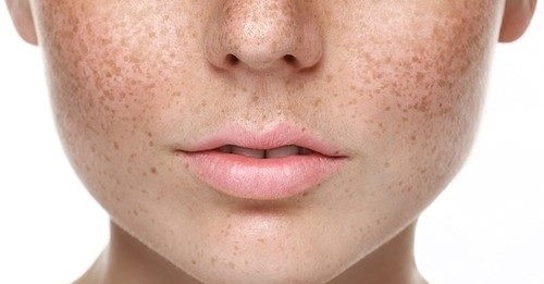 Best Pigmentation Treatment in Viman Nagar