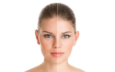 Blogs 1 What Is the Best Treatment for Pigmentation on the Face?