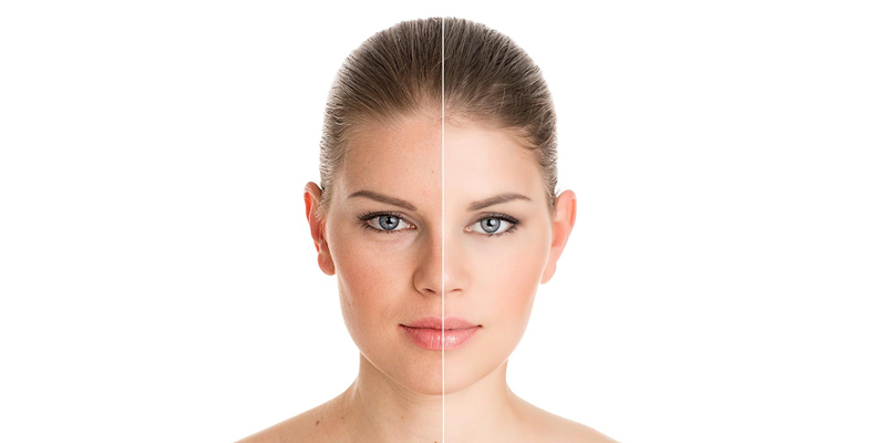 What Is the Best Treatment for Pigmentation on the Face?